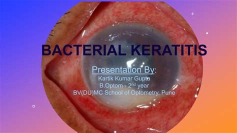 Bacterial keratitis | PPT