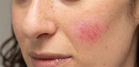 Couperose cosè Viso creme migliori rimedi naturali e laser