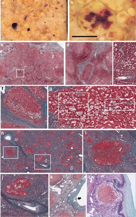 Congestive Injury In Cirrhotic Livers A B Gross Appearance Of Cut