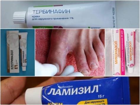 Кремы и мази от грибка на ногах между пальцами - обзор лучших и ...