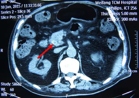 治疗性内镜逆行胰胆管造影术（ercp）技术