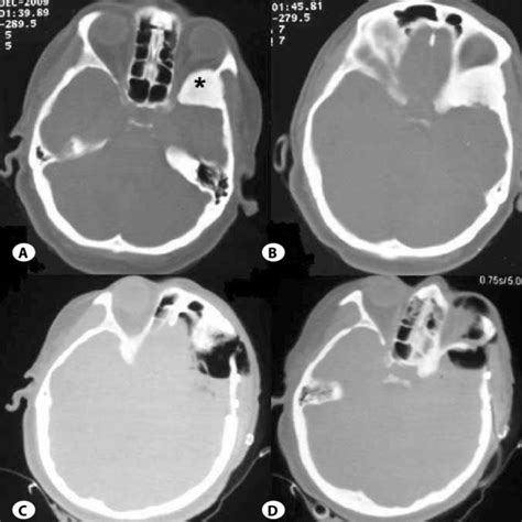 The Preoperative Ct Scans A B Of A Patient With Bony Invasion Black Download Scientific