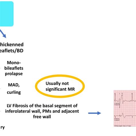 Mitral valve prolapse (MVP): fibroelastic deficiency (FED), Barlow’s ...