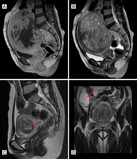 Uterine Fibroids As Related To Endometrial Cancer Pictures