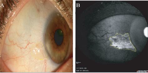 Figure 2 From Clinical And Autofluorescence Findings In Eyes With