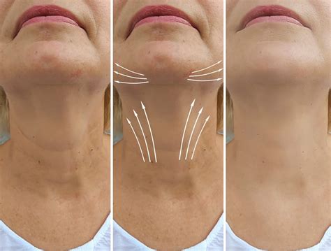 Understanding The Nefertiti Neck Lift Key Facts