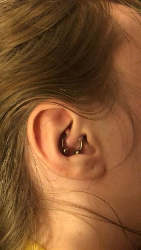 Keloid Bump From Piercing