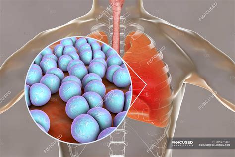 Pneumonia Caused By Streptococcus Pneumoniae Bacteria Conceptual