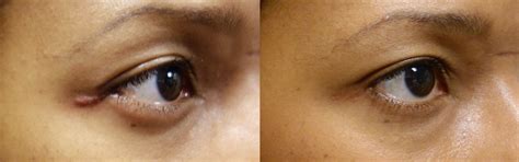 Lower Blepharoplasty Scars