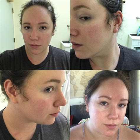 Rosacea Vs Lupus Butterfly Rash