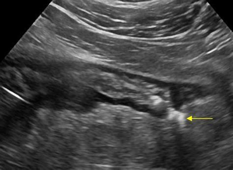 Abdomen and retroperitoneum | 1.6 Gastrointestinal tract : Case 1.6.1 Diverticulosis and ...