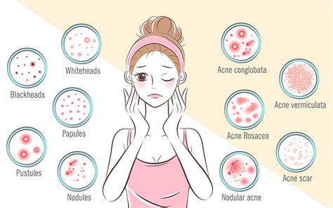 Tips for Preventing Teenage Acne » TeenWire.org