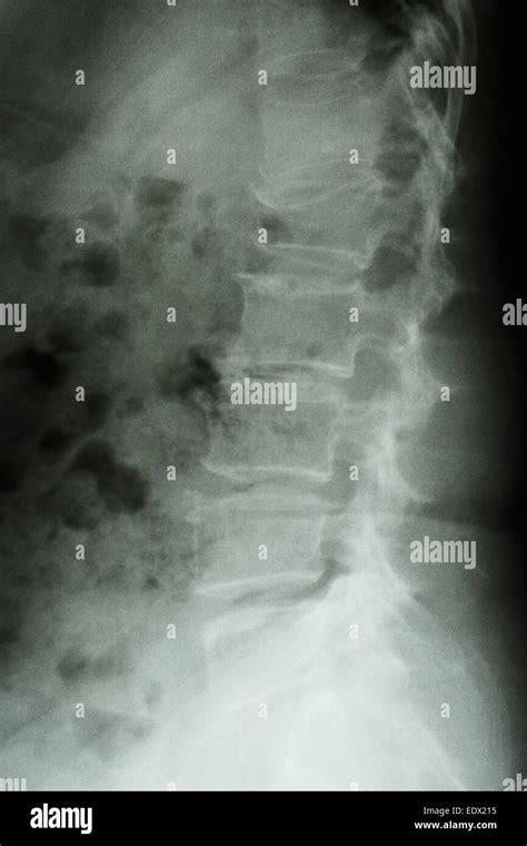 Film X Ray Lumbar Spine Lateral Show Burst Fracture At Lumbar Spine