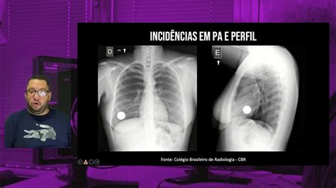 Radiografia De Tórax Duas Incidências Youtube