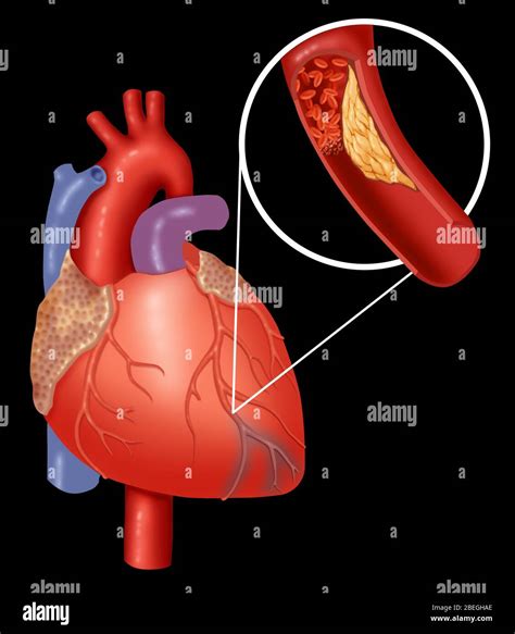 Infarto Agudo Del Miocardio Fotografías E Imágenes De Alta Resolución