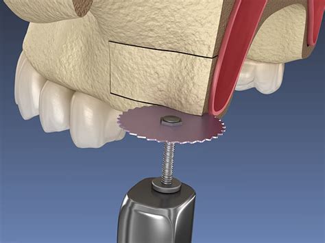 Elevación de seno abierta y cerrada Clínica Dental en Zaragoza