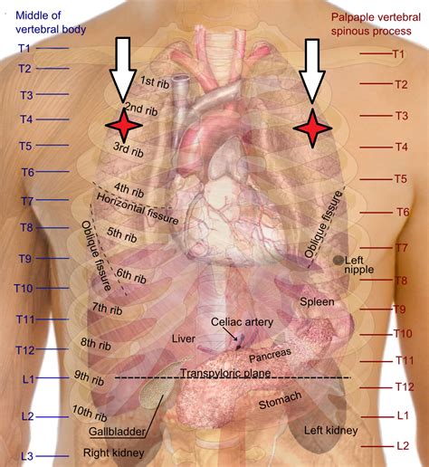 Decompression Tension Pneumothorax Needle Decompression