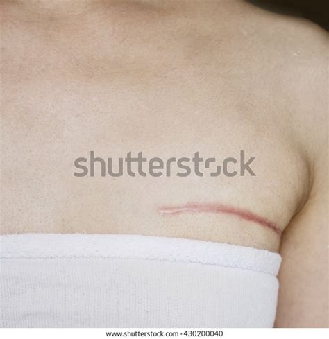 Breast Cancer Surgery Scars By Partial Stock Photo 430200040 | Shutterstock