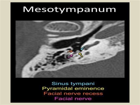 Presentation1.pptx, ct high resolution anatomy of the petrous bone.