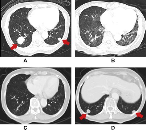 Contrast Enhanced Chest Computed Tomography Ct Years After