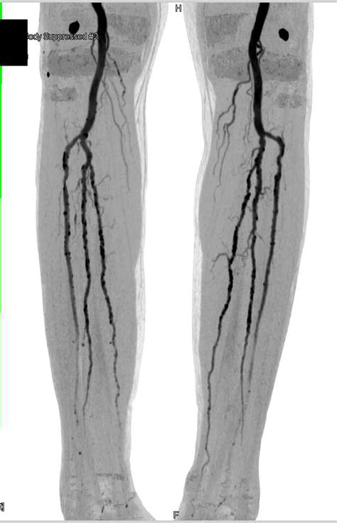 Dual Energy Ct Angiogram With Peripheral Vascular Disease Vascular