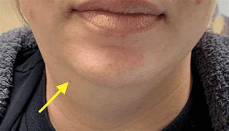 5 Health Issues That May Lead To Double Chin