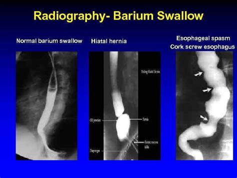 Esophagus Rita Brun Md Gastroenterology Department Rambam Health