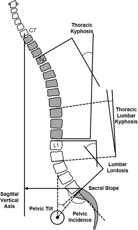 Sagittal Spino Pelvic Radiographic Parameters Included Tk Tlk Ll Pi