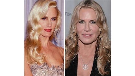 Worst Cases Of Celebrity Plastic Surgery Gone Wrong