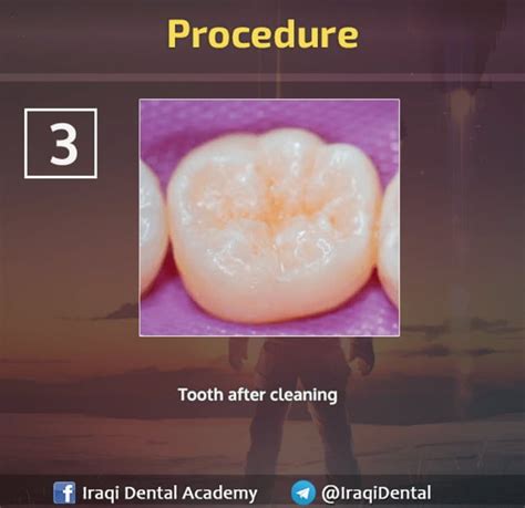 Fissure Sealant Procedure Explained