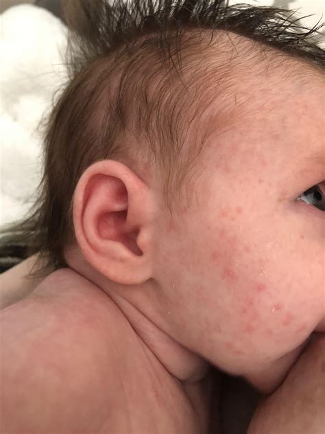 Causes And Treatments For Baby Acne