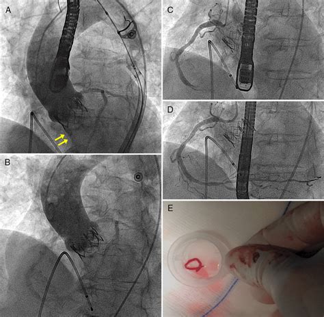 A Aortography With Mild To Moderate Regurgitation Arrows Through