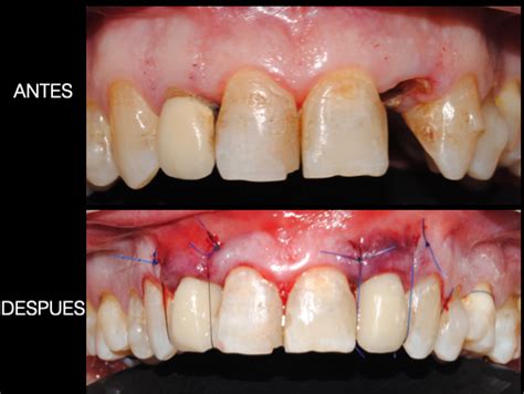 Caso tratado Cirugia plástica periodontal Clínica Sánchez Colodro