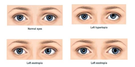 Strabismus Eye Surgery And All About It Healing Consulting Turkey