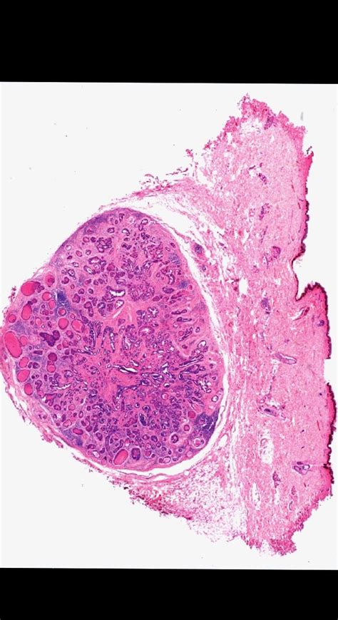 Pathology Of Sebaceous Adenoma Artofit