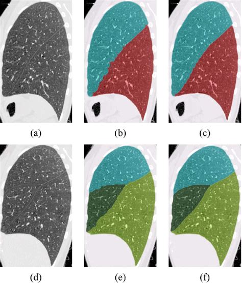 Figure 1 From Anatomy Guided Lung Lobe Segmentation In X Ray Ct Images Semantic Scholar