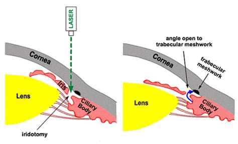 Laser Iridotomy For Angle Closure Glaucoma Vision And Eye Health