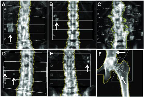 Illustration Of Six Examples Of Calcification On DEXA Imaging Arrows