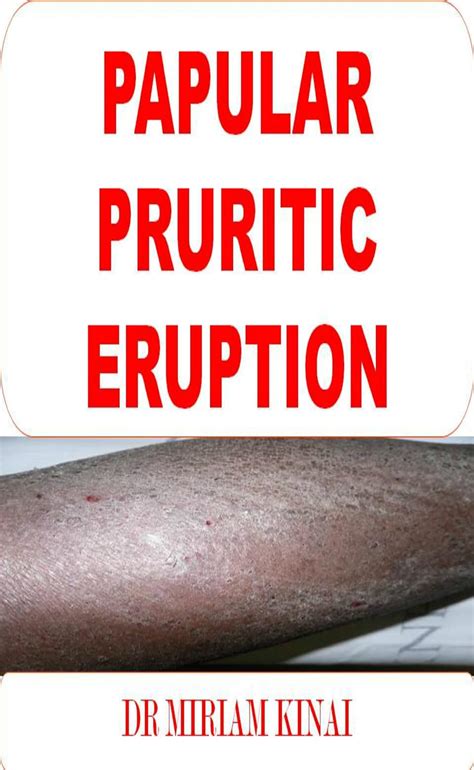 Dermatology Papular Pruritic Eruption Ppe Skin Diseases Book 22 Kindle Edition By Kinai