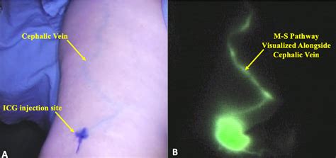 Figure 2 From Real Time Visualization Of The Mascagni Sappey Pathway