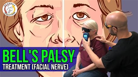 Bells Palsy Treatment Facial Nerve Youtube