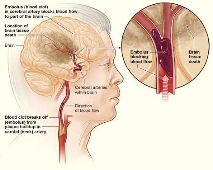 Stroke Causes And Risk Factors Nhlbi Nih