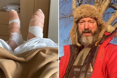 Tom Green Shares Photos Of His Feet Severely Burned After Terrifying Campfire Accident That Left