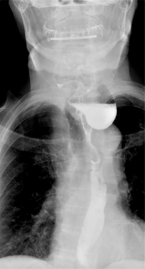 Anterior Posterior View Of A Barium Esophagogram Showing Contrast