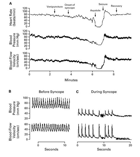 Neurocardiogenic Syncope New England Journal Of Medicine