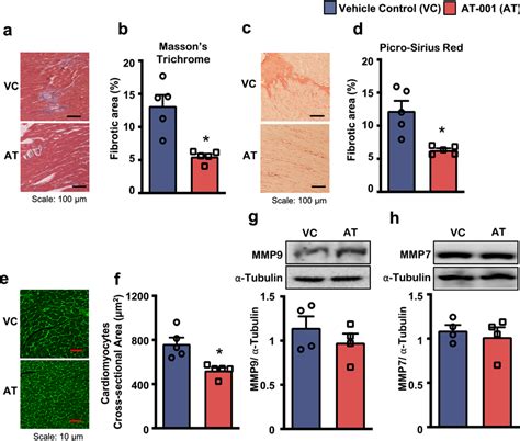 AT 001 Mitigates Cardiac Fibrosis And Hypertrophy In DbCM Af