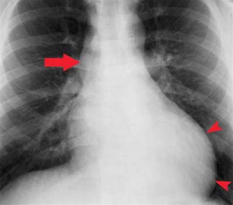 Cardiac Anatomy Physiolgy And Imaging Modalities Radiology Key