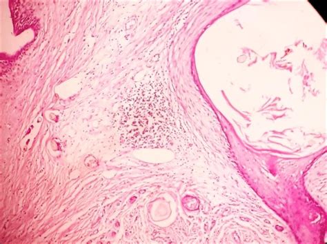 The Photomicrogram Of Ovarian Mature Cystic Teratoma With Secondary