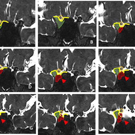 Cerebral Digital Subtraction Angiography DSA Of Intradural Aneurysm