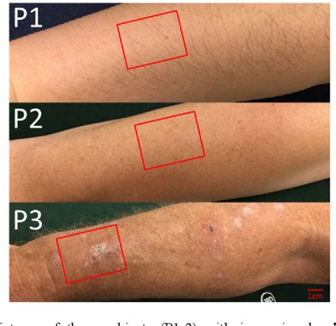 Figure 1 From Noninvasive Mesoscopic Imaging Of Actinic Skin Damage